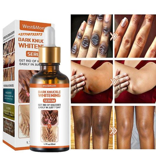 Dark Knuckle Whitening Serum In Garnett City in Kansas, Elbow And Knee Brightening Serum In Malung Municipality in Sweden Call ☏ +2771 073 2372 Get Rid Of Tattoos In Polokwane City, Dark Spots Products In Montagu Town In South Africa