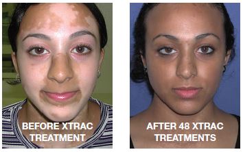Get Rid Of Vitiligo In Haddam City in Kansas, United States And Vaasa City In Finland Call +27710732372 Scars And Stretch Marks In Grycksbo Municipality in Sweden And Vereeniging City In South Africa