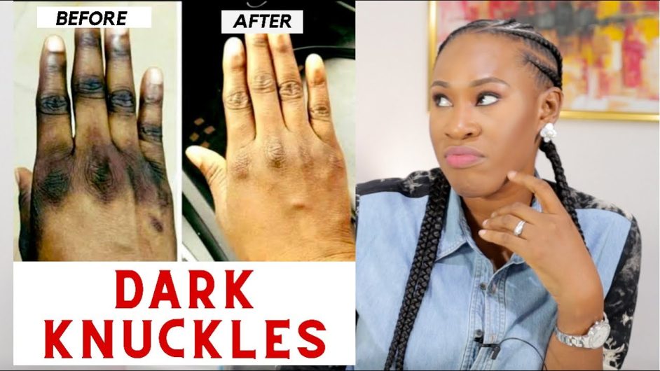 Dark Knuckle Whitening Serum In Garnett City in Kansas, Elbow And Knee Brightening Serum In Malung Municipality in Sweden Call ☏ +2771 073 2372 Get Rid Of Tattoos In Polokwane City, Dark Spots Products In Montagu Town In South Africa