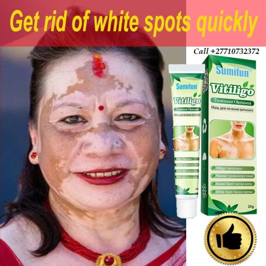 Get Rid Of Vitiligo In Haddam City in Kansas, United States And Vaasa City In Finland Call +27710732372 Scars And Stretch Marks In Grycksbo Municipality in Sweden And Vereeniging City In South Africa